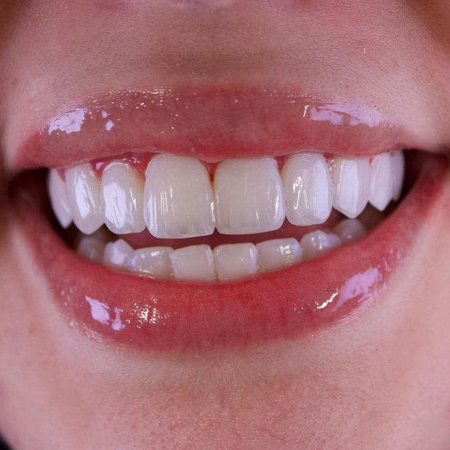 Lentes de Contato Dental